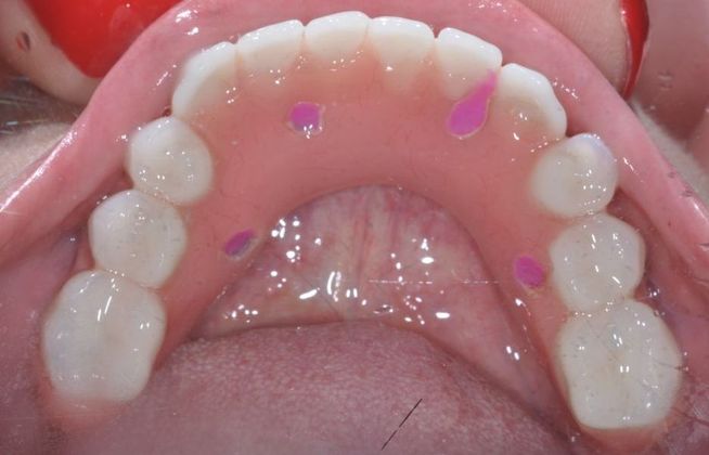 Teeth In A Day: Case 8 - Lower Arch