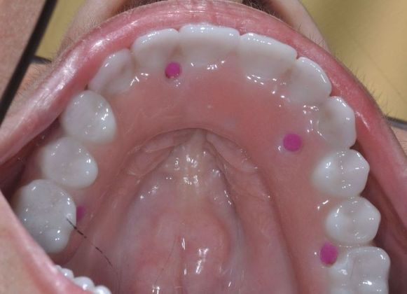 Teeth In A Day: Case 8 - Upper Arch