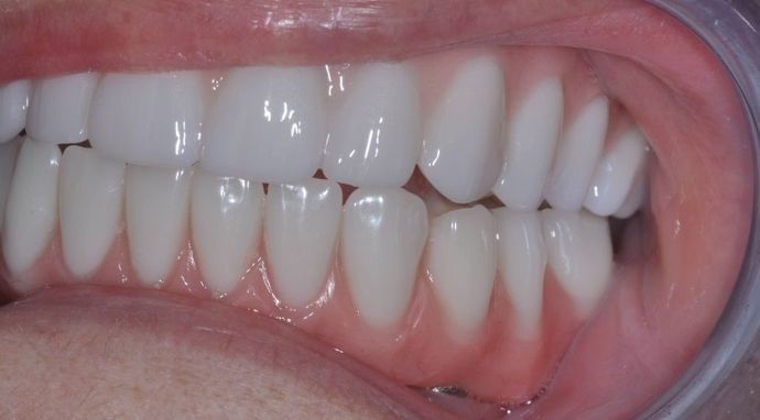 Teeth In A Day: Case 8 - After