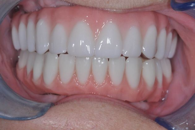 Teeth In A Day Case 8 - After