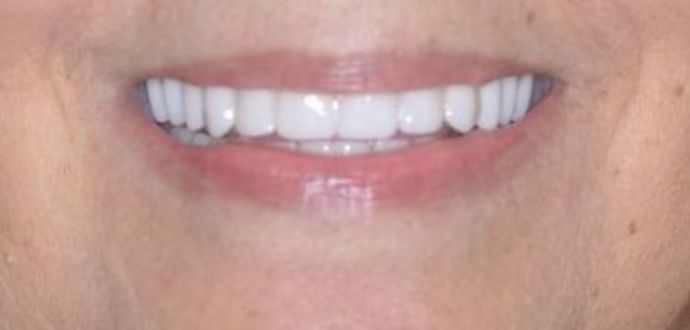 Teeth In A Day: Case 8 - After