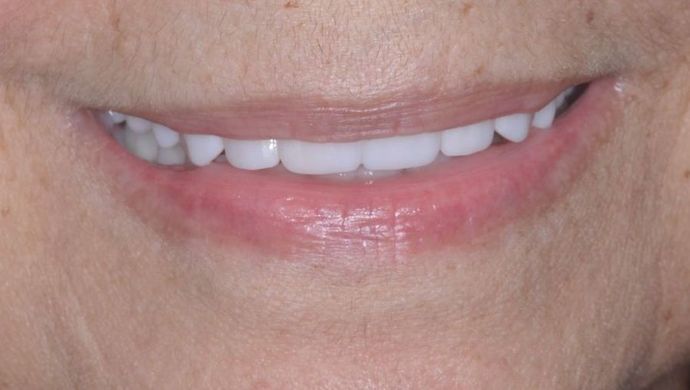 Teeth In A Day: Case 8 - After