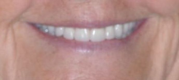 Teeth In A Day Case 10 - Before