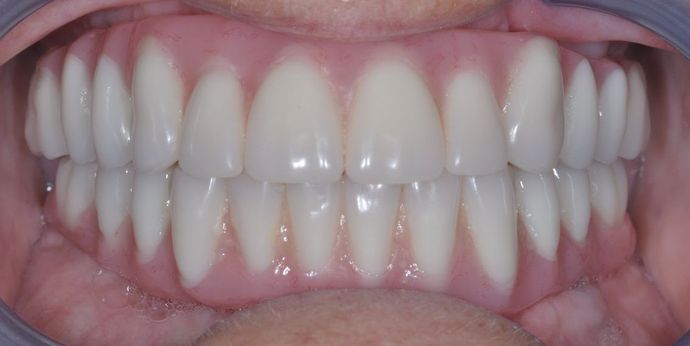 Teeth In A Day: Case 10 - Upper and Lower Arch