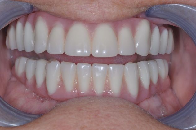 Teeth In A Day: Case 10 - After