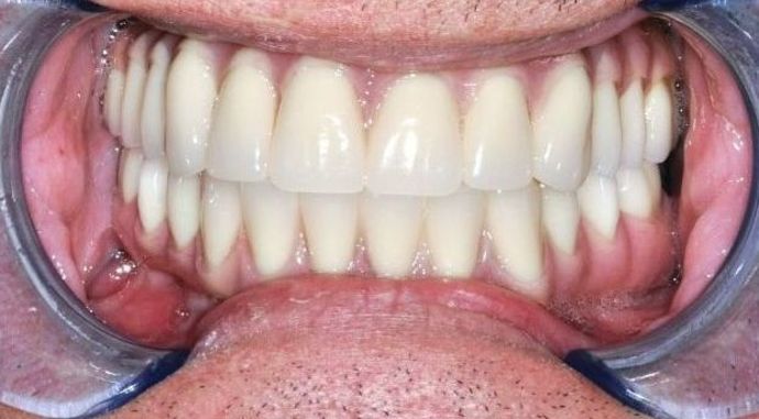 Teeth In A Day Case 12 - After