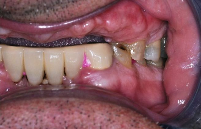 Dental Implants Case 3 - Before