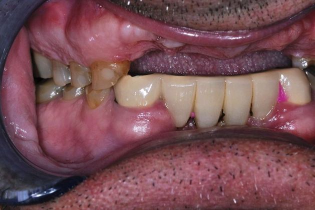 Dental Implants: Case 3 - Before