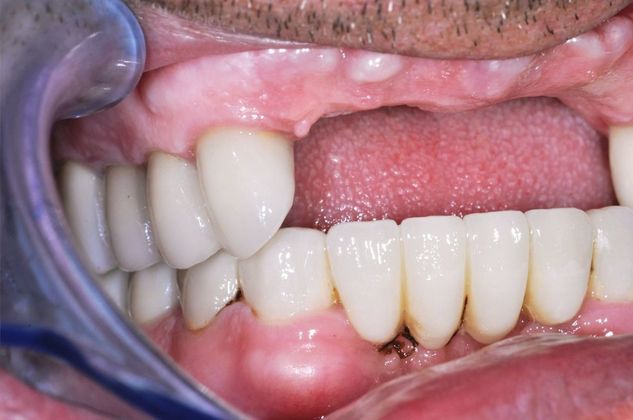 Dental Implants: Case 3 - Before