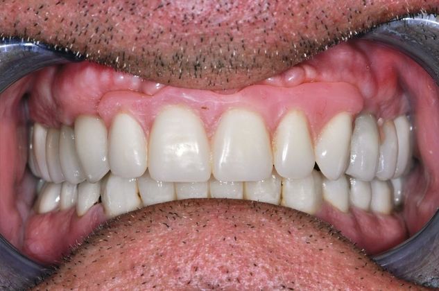 Dental Implants: Case 3 - After