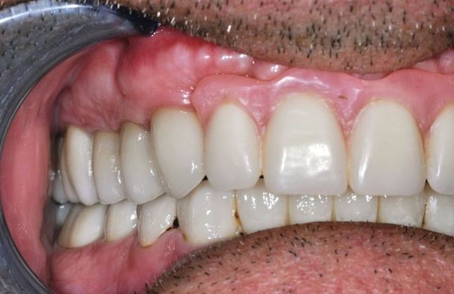 Dental Implants: Case 3 - Implant Bridge