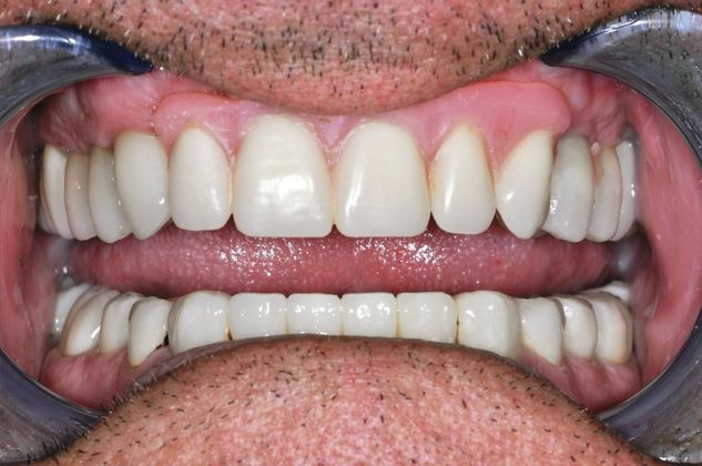 Dental Implants Case 3 - After