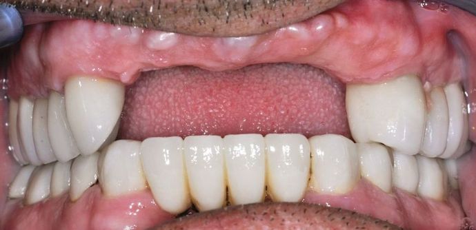 Dental Implants: Case 3 - Before