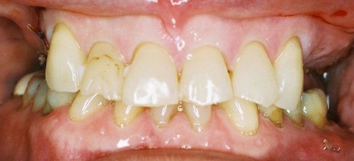 Dental Crowns Case 9 - Before