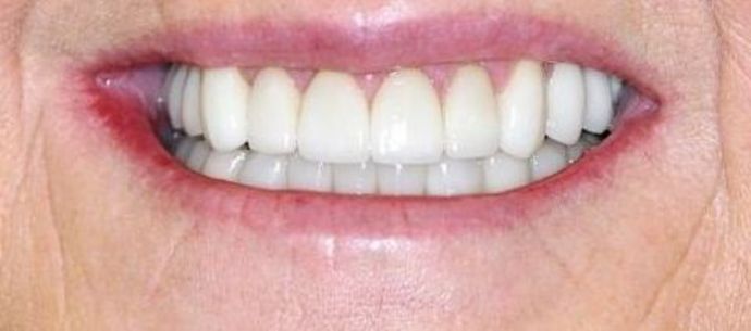 Dental Crowns Case 9 - After