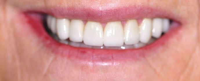 Dental Crowns: Case 9 - After