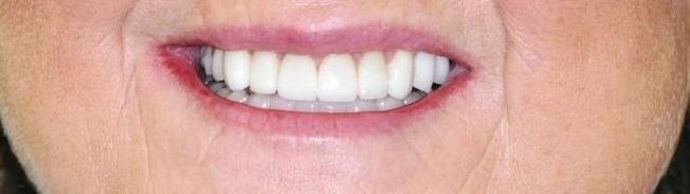 Dental Crowns: Case 9 - After