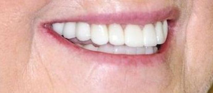 Dental Crowns: Case 9 - After