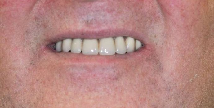 Teeth In A Day Case 13 - Before