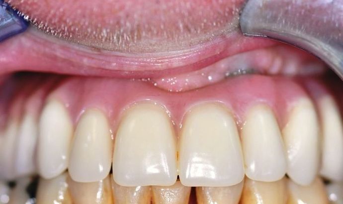 Teeth In A Day Case 13 - After