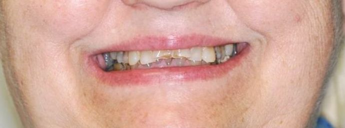 Full Mouth Reconstruction Case 3 - Before