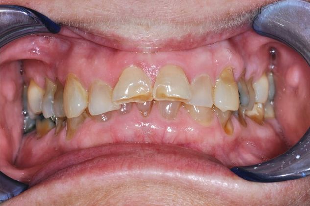 Full Mouth Reconstruction: Case 3 - Before