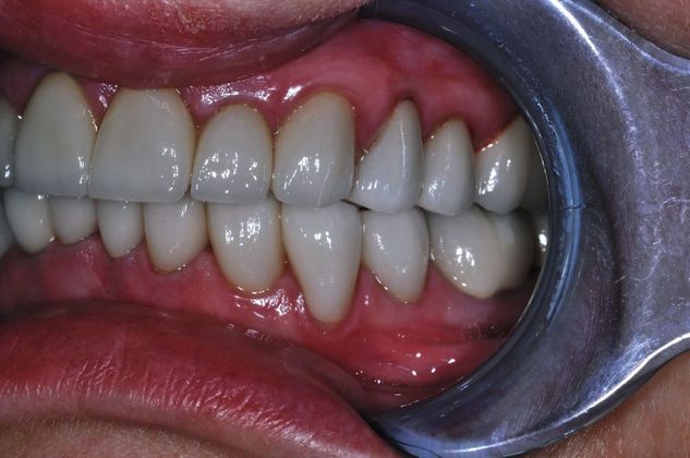Full Mouth Reconstruction: Case 3 - After