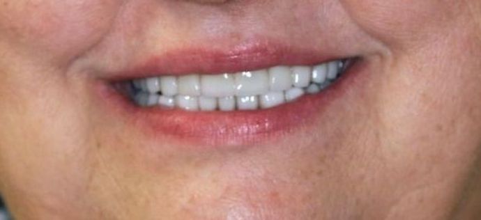 Full Mouth Reconstruction Case 3 - After