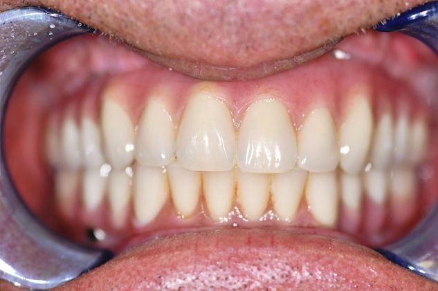 Teeth In A Day Case 15 - Before