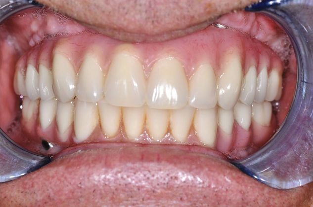 Teeth In A Day Case 15 - After