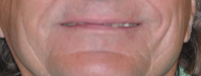 Dental Crowns Case 12 - Before