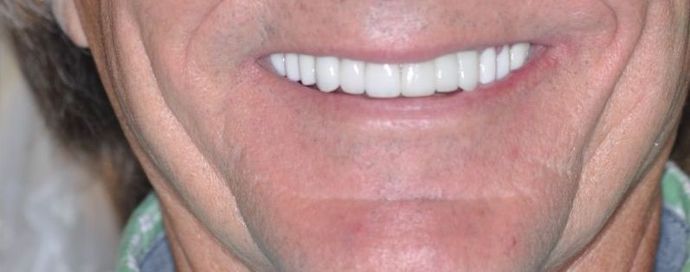 Dental Crowns Case 12 - After