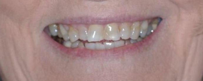 Dental Crowns Case 13 - Before