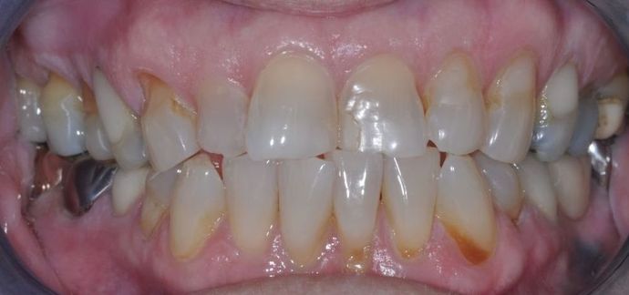 Dental Crowns: Case 13 - Before