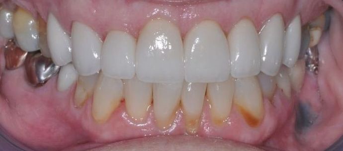 Dental Crowns: Case 13 - After