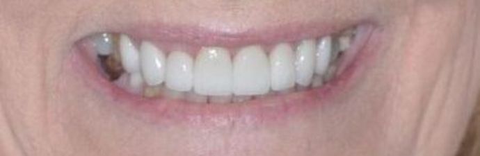 Dental Crowns Case 13 - After