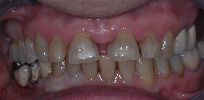 Dental Crowns: Case 14 - Before