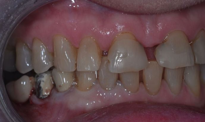 Dental Crowns: Case 14 - Before