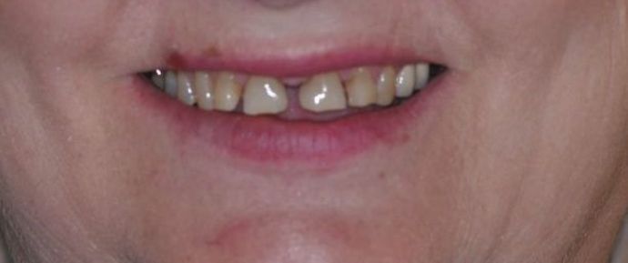 Dental Crowns Case 14 - Before