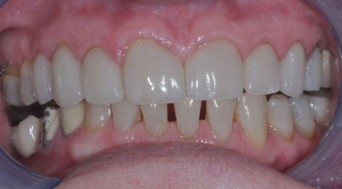 Dental Crowns: Case 14 - After