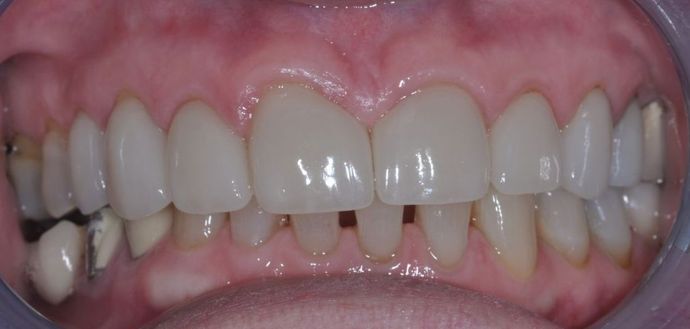 Dental Crowns: Case 14 - After