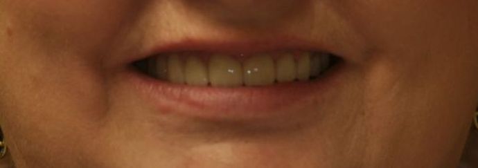 Dental Crowns Case 14 - After