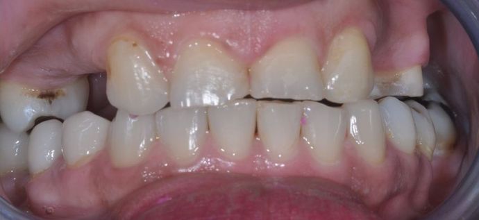 Dental Crowns: Case 16 - Before