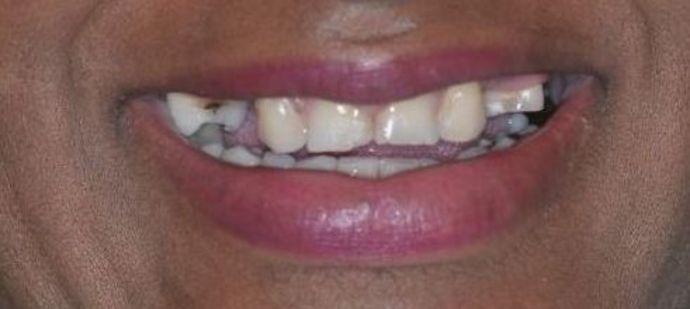 Dental Crowns Case 16 - Before