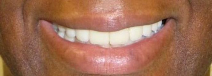 Dental Crowns Case 16 - After