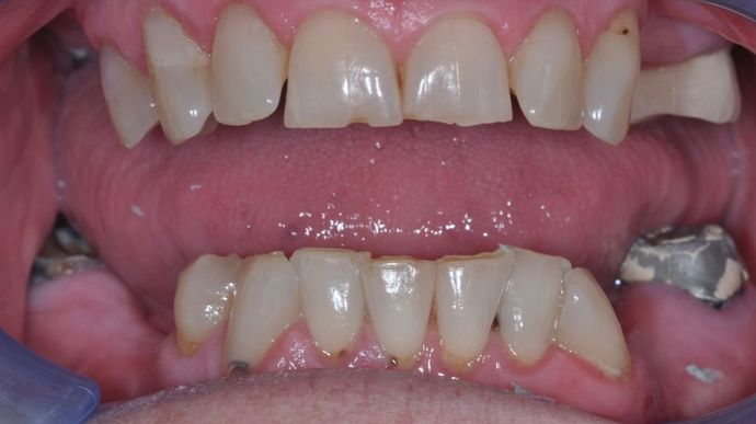 Teeth In A Day: Case 10 - Before