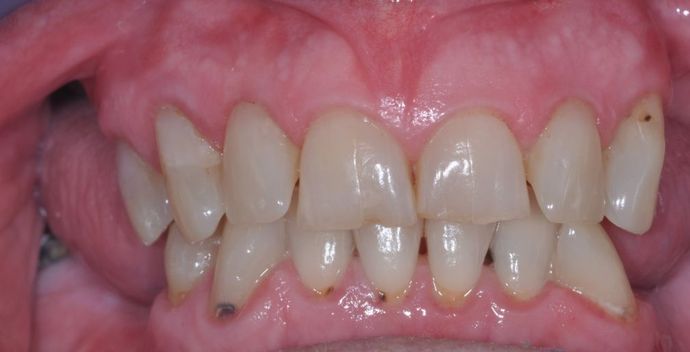 Teeth In A Day: Case 10 - Before