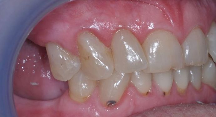 Teeth In A Day: Case 10 - Before