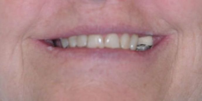 Teeth In A Day Case 10 - After