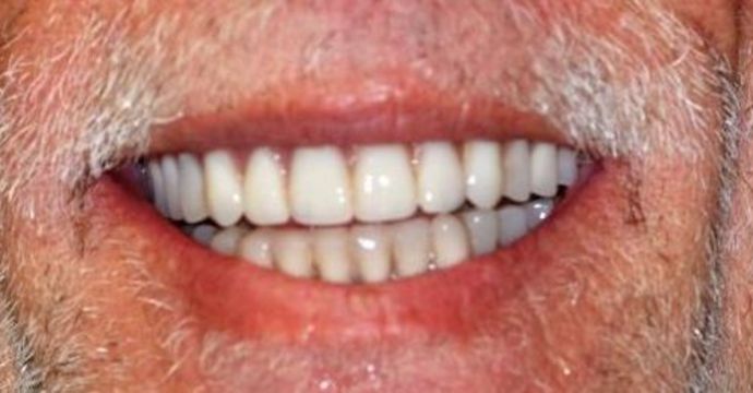 Teeth In A Day Case 17 - After